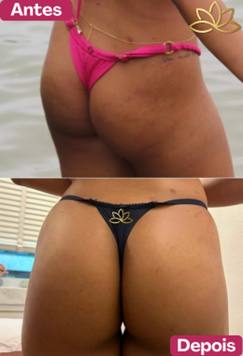 Antes e depois de paciente do Sculpt B