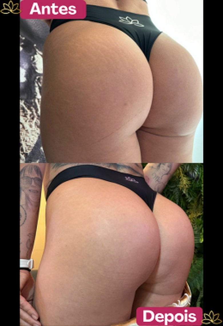 Antes e depois de paciente do Sculpt B