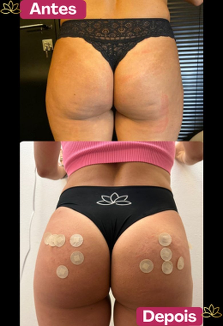 Antes e depois de paciente do Sculpt B